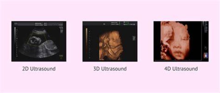 How accurate is 2d ultrasound?