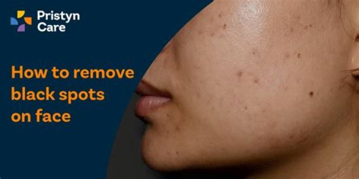 How can I remove black spots on my body?