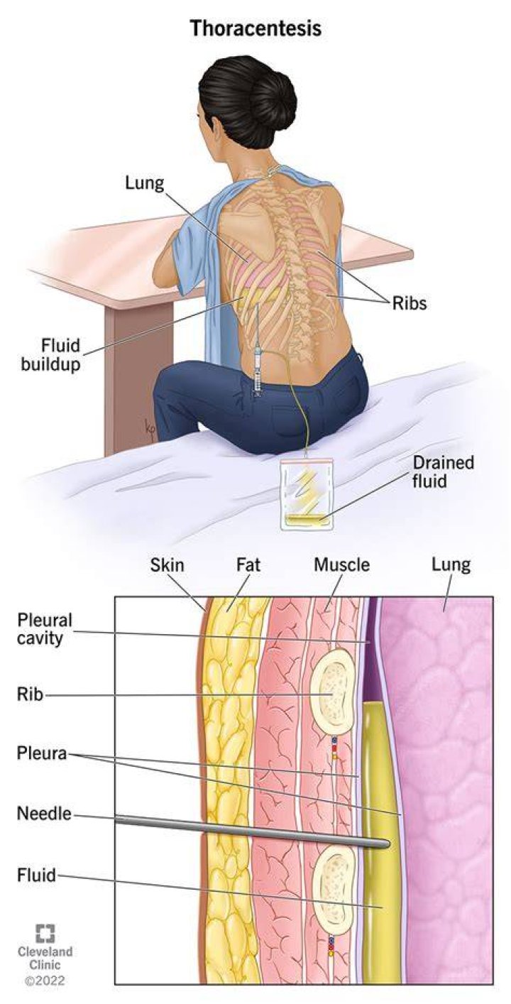 Is thoracentesis procedure painful?