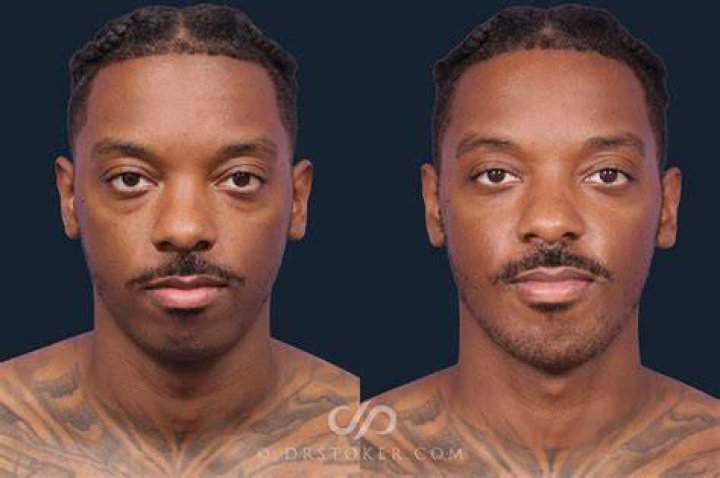 Michael B. Jordan Plastic Surgery: Look at His Face Before and After Jaw Surgery!