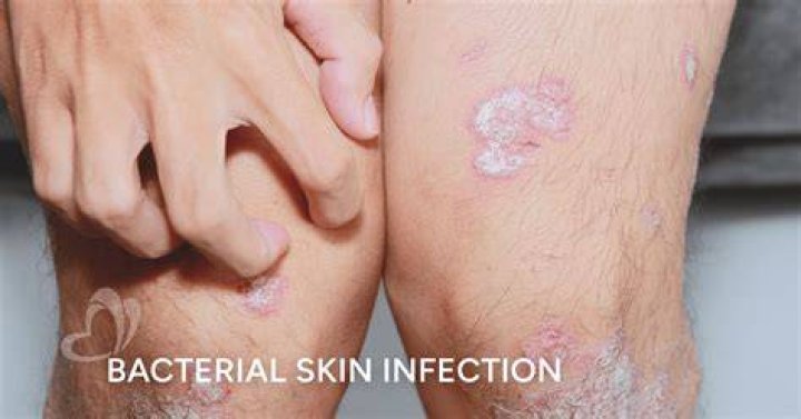 What does a bacterial infection of the skin look like?