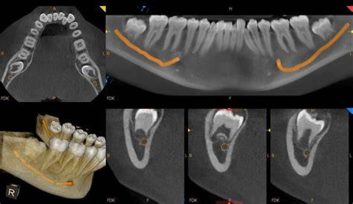 What is a CBCT dental scan?