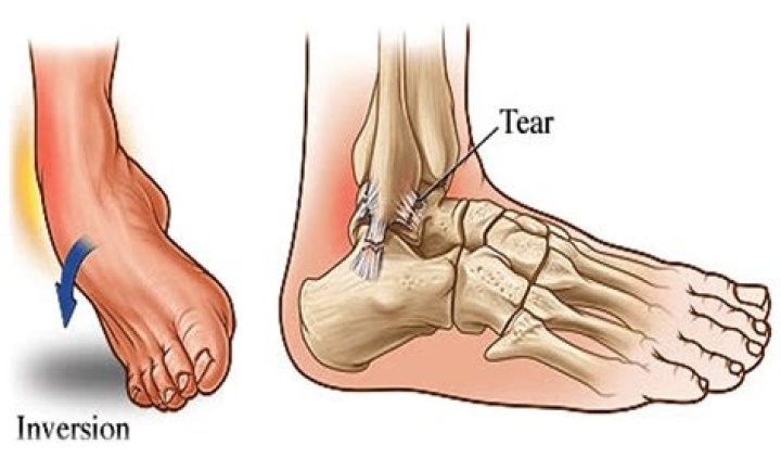 What is acute ankle sprain?